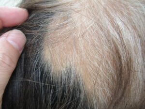 多発型円形脱毛症　内服、外用、エキシマで治癒期。